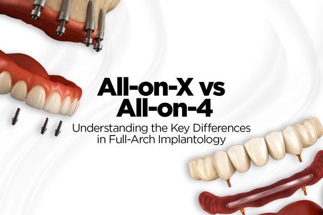 All-on-X vs All-on-4
