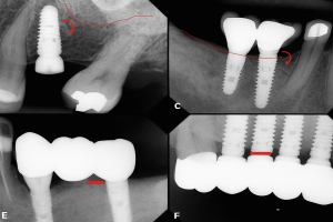Inter-Implant Distance