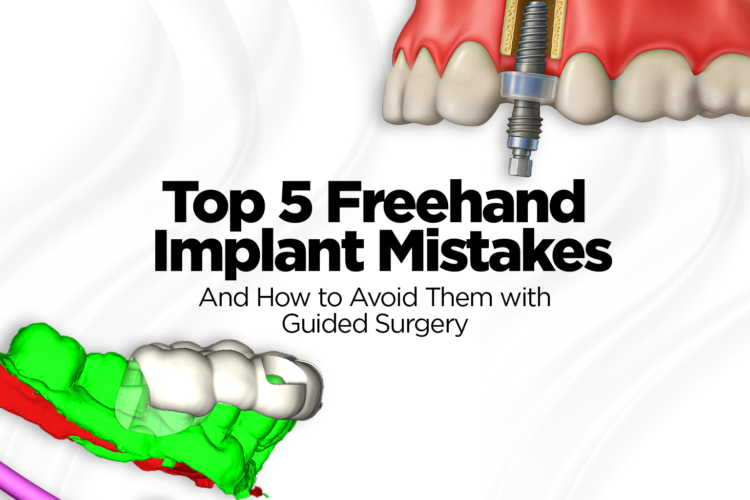 Top 5 Freehand Implant Mistakes and How to Avoid Them with Guided ...