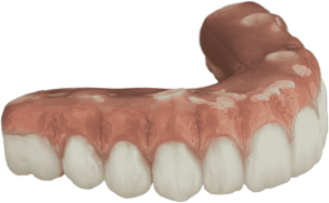 Full Arch Zirconia
