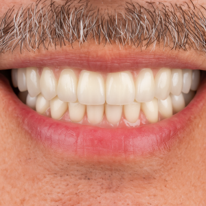 Superior Strength Full Arch Zirconia