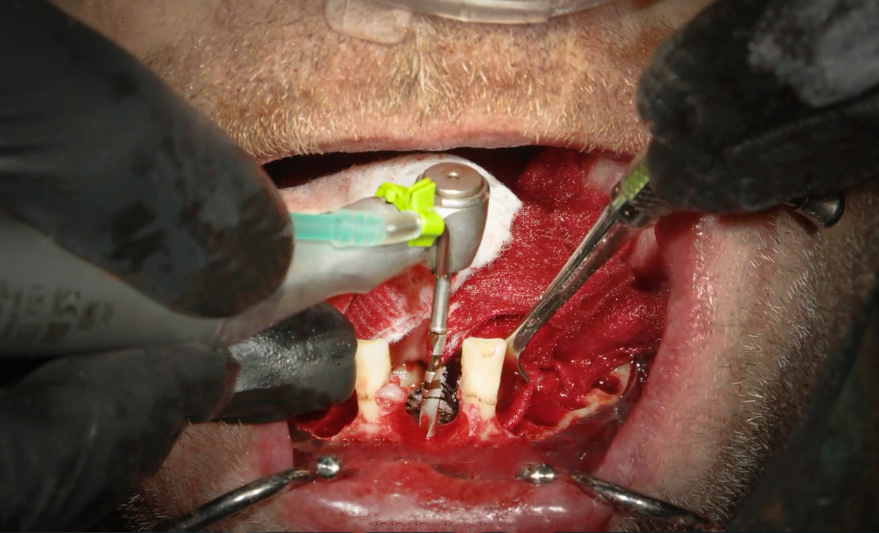 Top 5 Freehand Implant Mistakes and How to Avoid Them with Guided ...