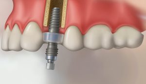 full arch guided study