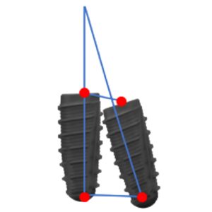 improper implant angulation