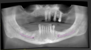 Panoramic-View-preoperative-scaled