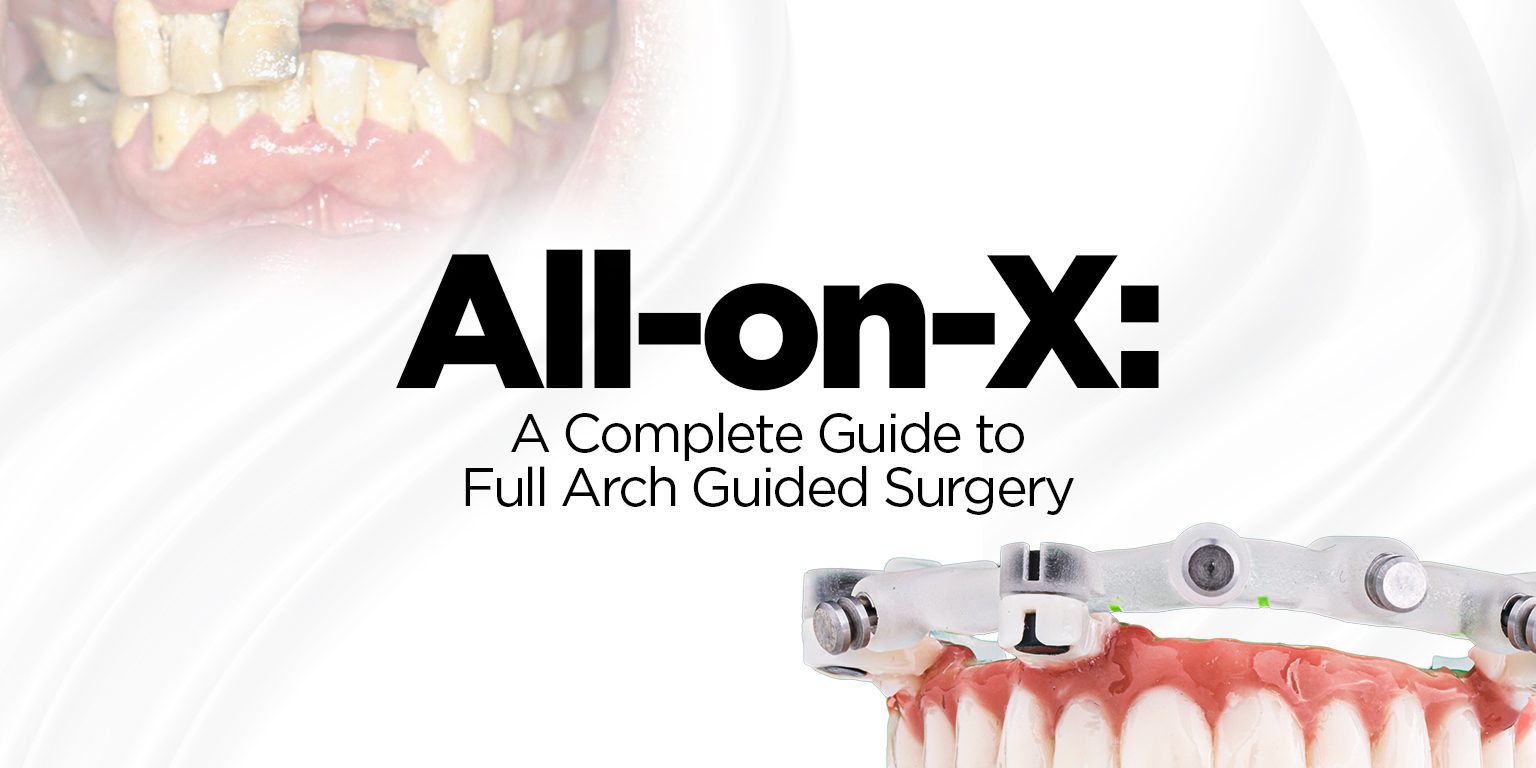 All-on-X a complete guide