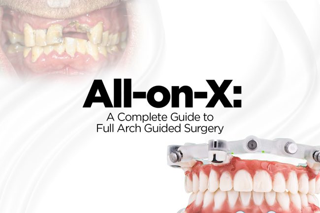 All-on-X a complete guide